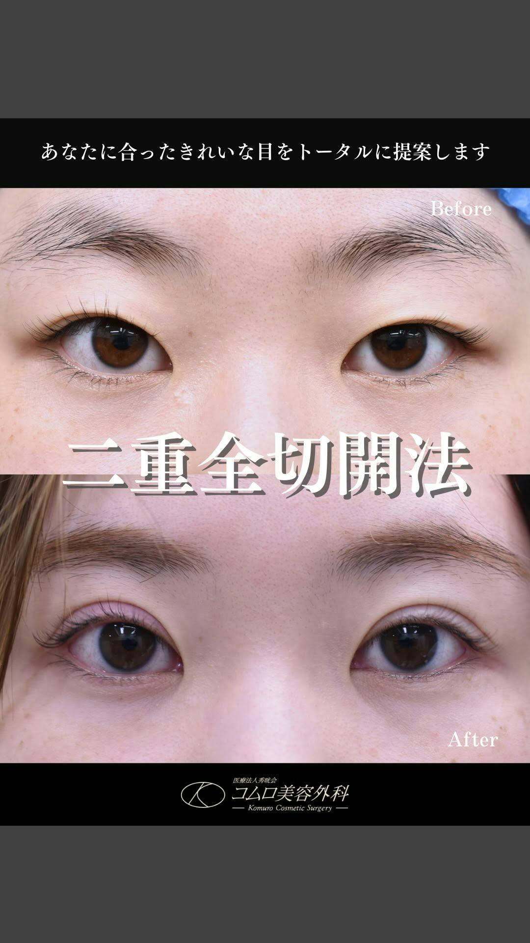 【20代女性・目元】二重全切開法_before_aftar