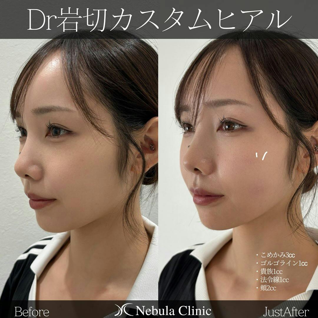 【女性・輪郭】ヒアルロン酸注入_before_aftar