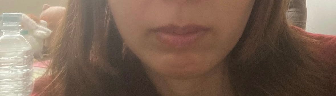 品川スキンクリニック梅田院でボトックス注射・顎のボトックス注射・韓国製ボトックス・ボツリヌストキシン・アラガン製ボトックスを受けたみみこさんの写真