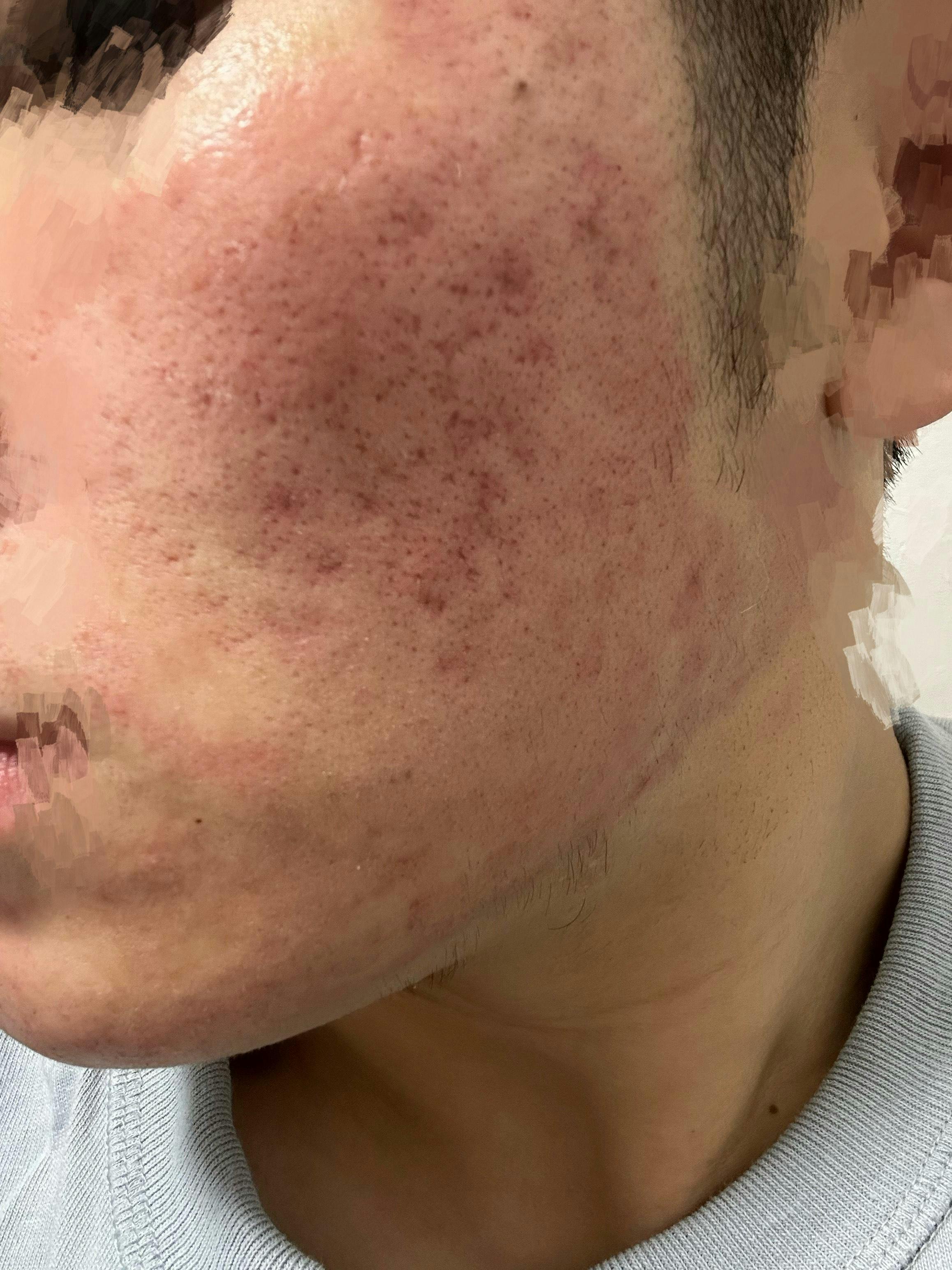 湘南美容クリニック 水戸院でダーマペン：ダーマペンを受けたみみさんの写真