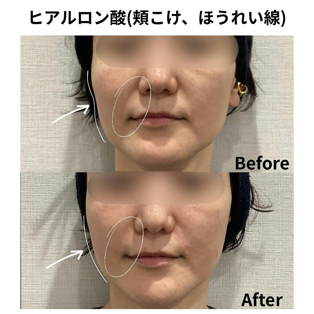 【女性・口元】ヒアルロン酸（頬コケ、ほうれい線）_before_aftar