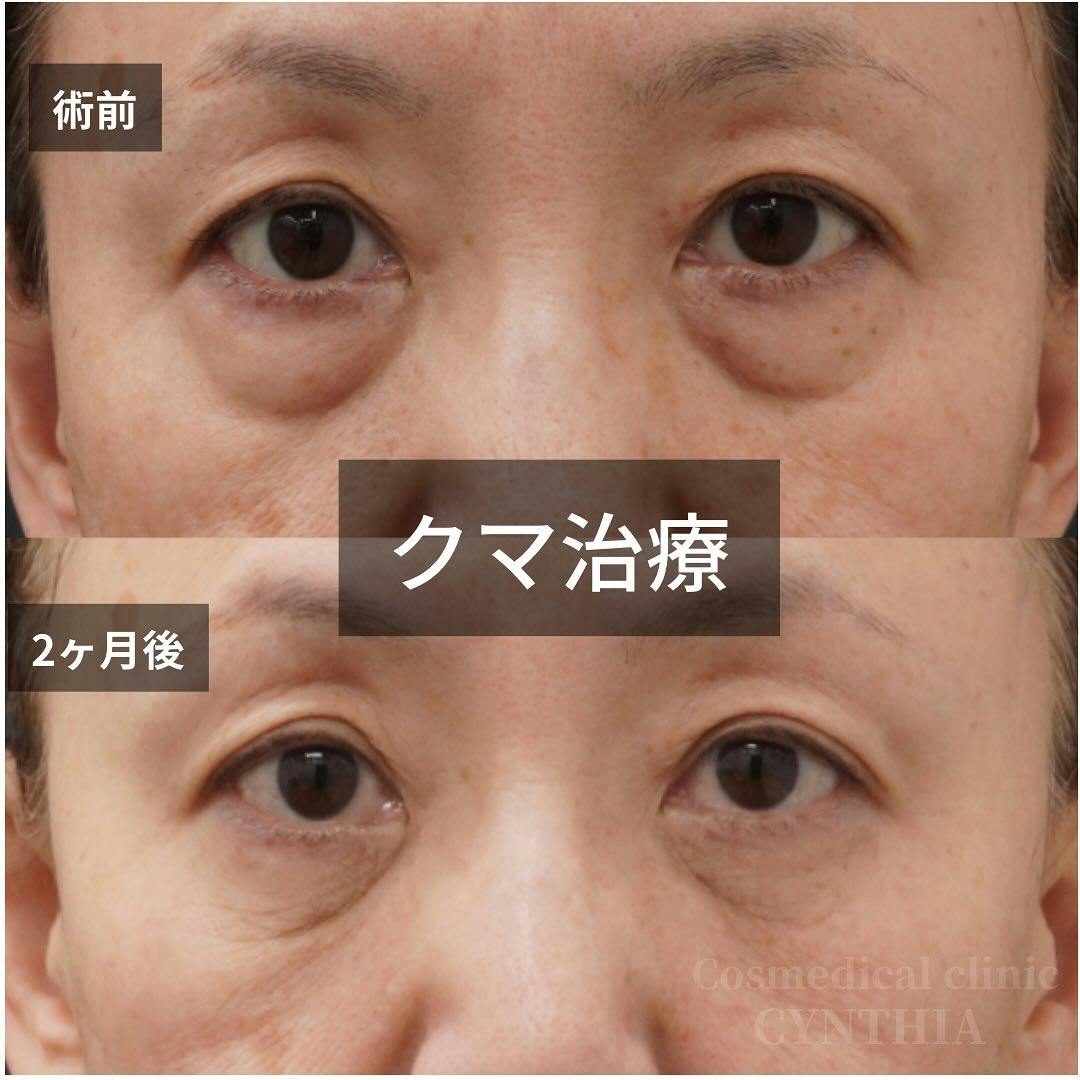 【60代女性・目元】目の下のクマ・たるみ取り_before_aftar