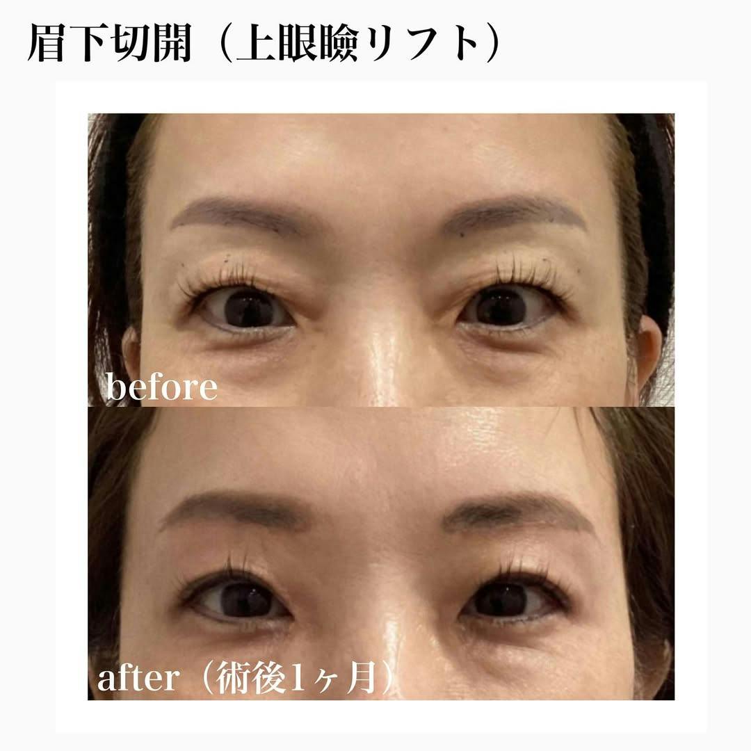 【女性・眉下】眉下切開（上眼瞼リフト）_before_aftar