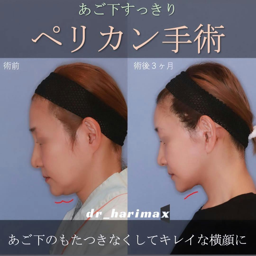 【女性・顎】ペリカン手術_before_aftar
