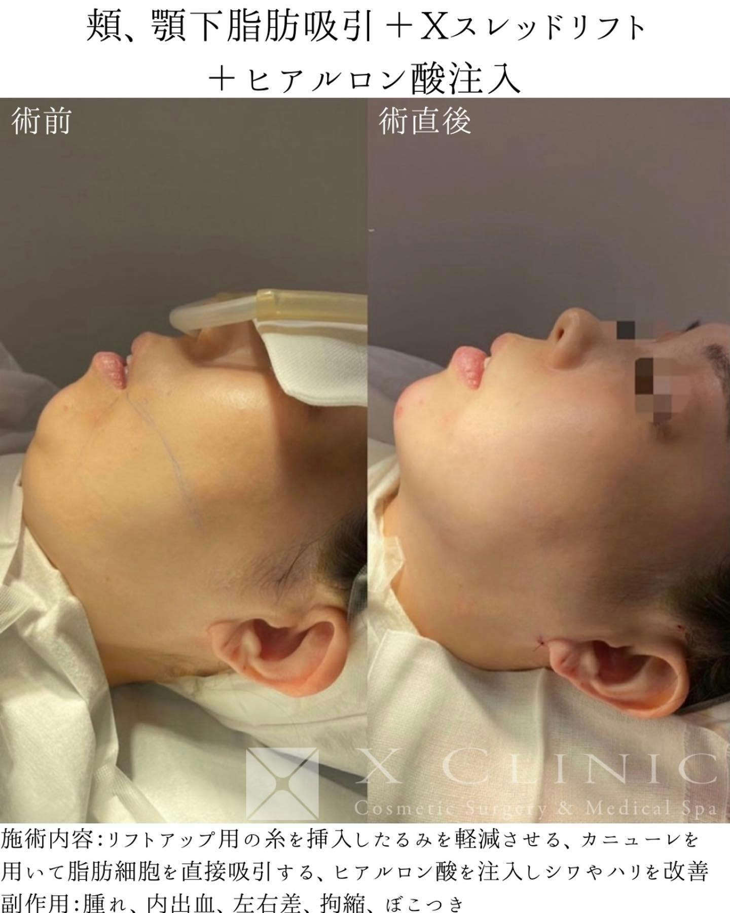 【女性・輪郭】頬顎下脂肪吸引 Xスレッドリフ  顎ヒアルロン酸注入_before_aftar