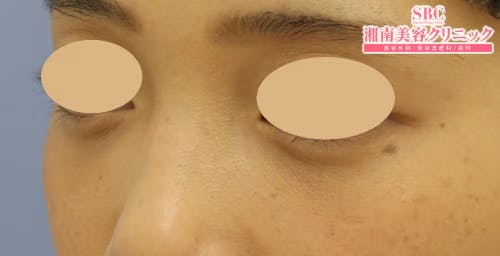 【女性・目元】目の下の切らないクマ・たるみ（ふくらみ）取り、ナチュラル脂肪注射コンデンスリッチ_aftar