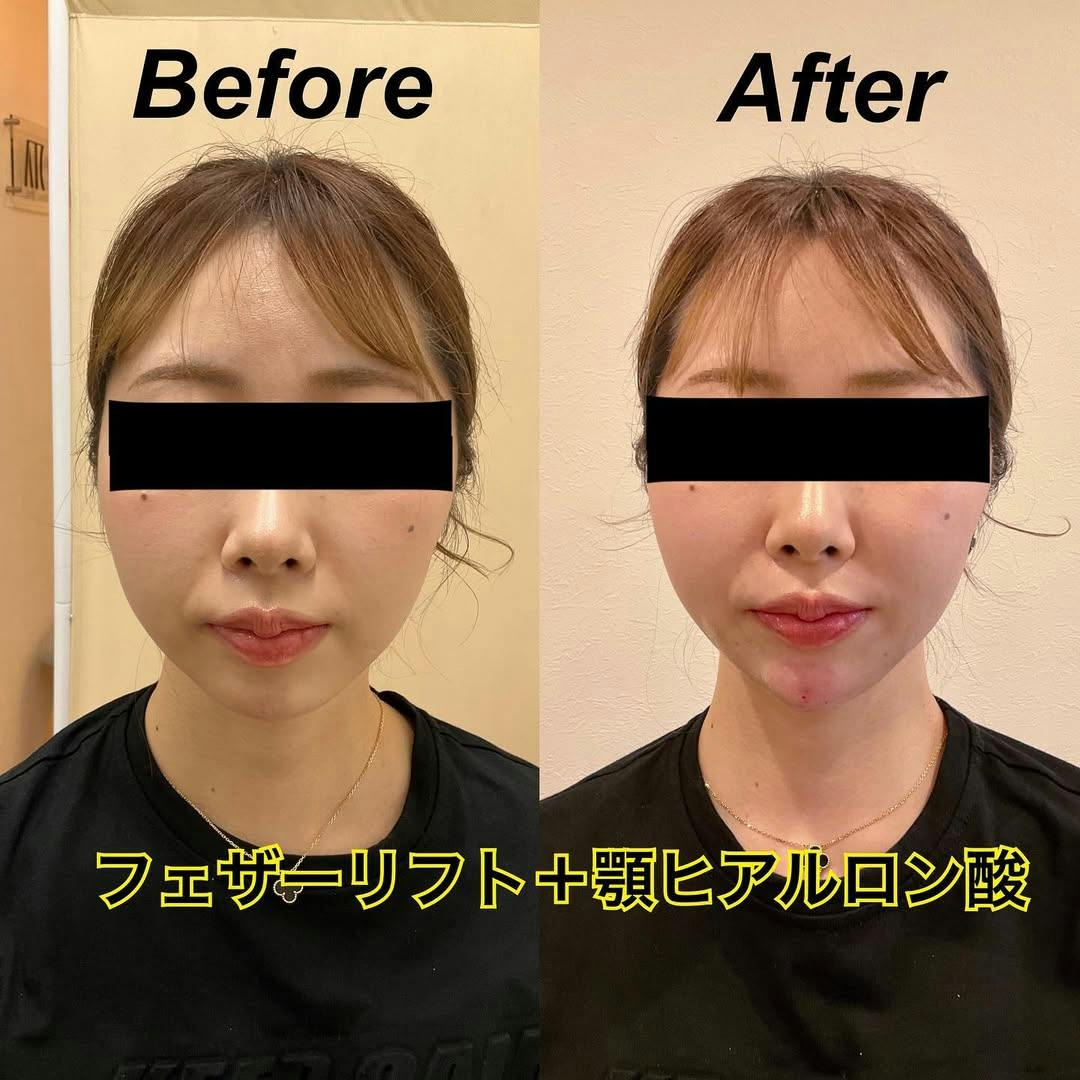 【女性・輪郭】フェザーリフト＋顎ヒアルロン酸_before_aftar