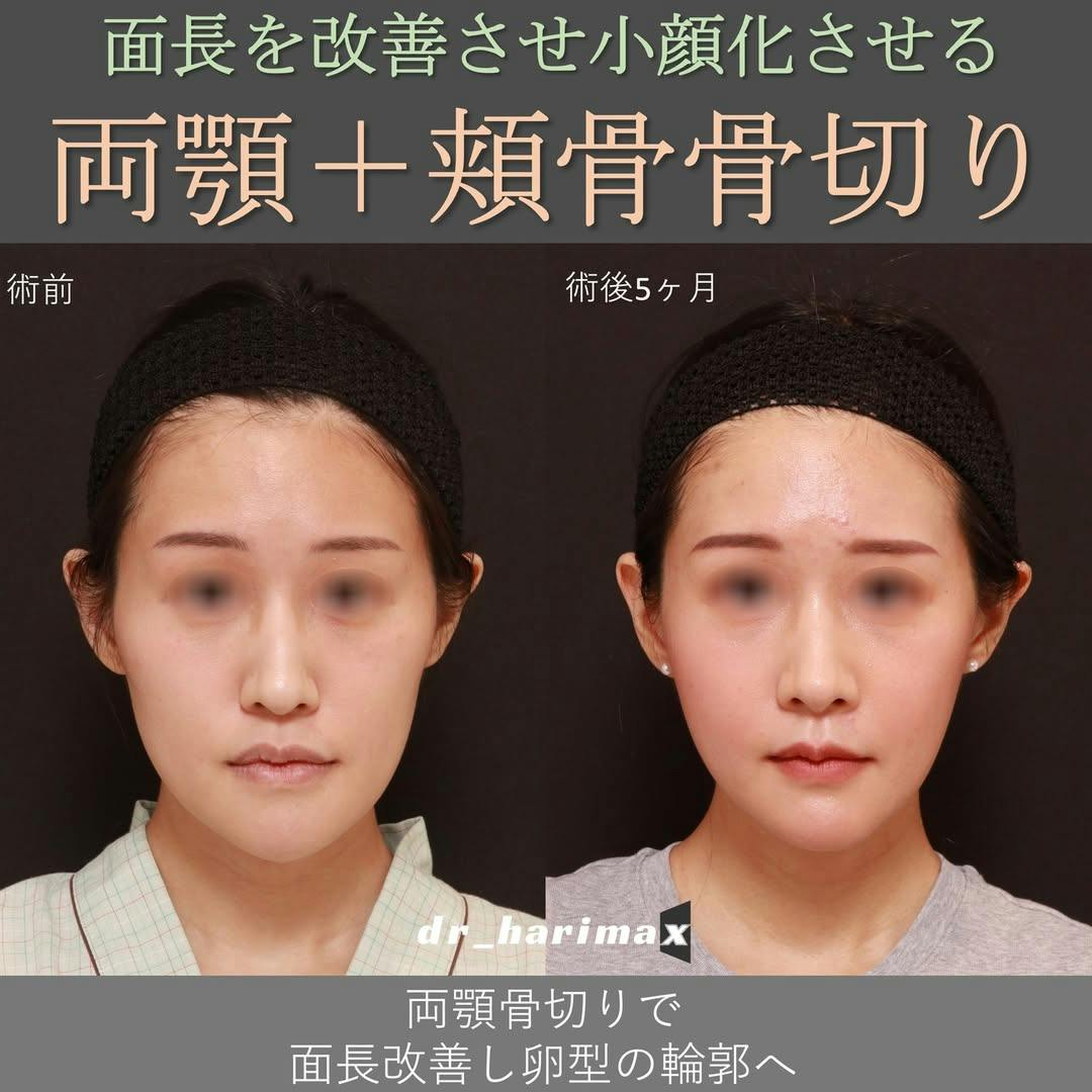 【女性・顎・頬】上下顎骨切り術・頬骨骨切り_before_aftar