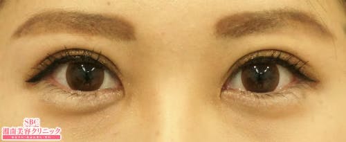 【20代女性・目元】クイックコスメティーク・ダブルNeo_after