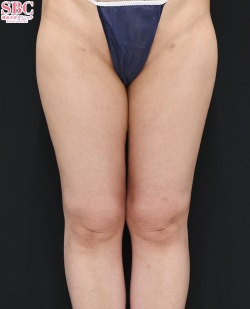 【30代女性・下半身】Aquicell（アキーセル）脂肪吸引・根こそぎVASER脂肪吸引_aftar