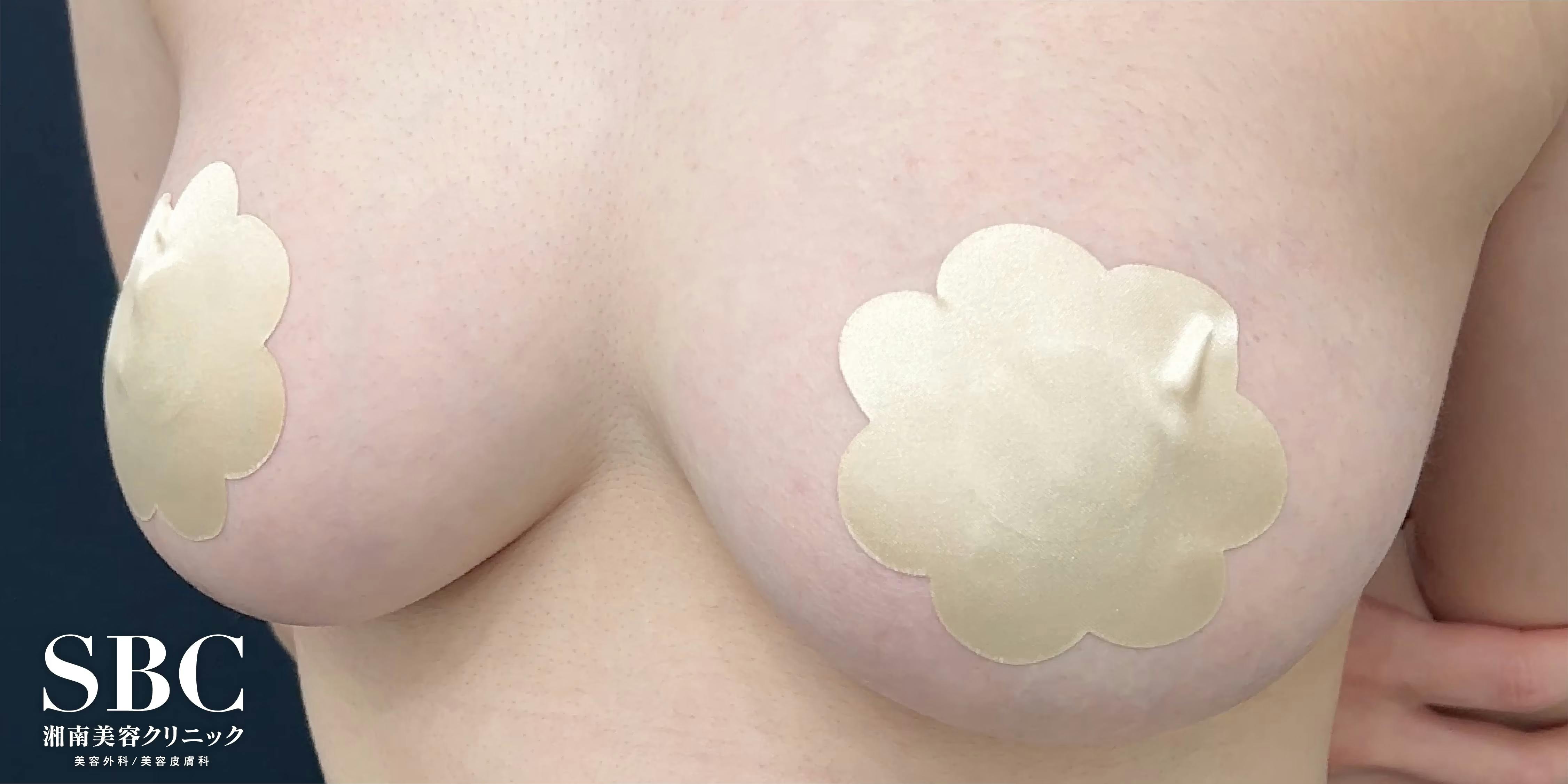 【女性・胸】Aquicell（アキーセル）併用コンデンスリッチ(脂肪注入豊胸) コールマン式_aftar