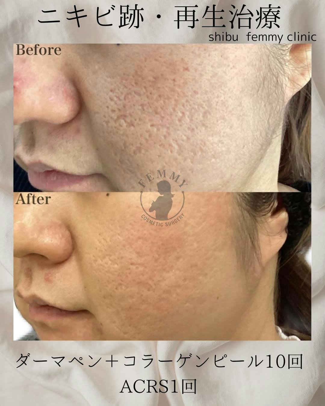 【男性・ニキビ跡】ダーマペンコラーゲンピール・ACRS_before_aftar