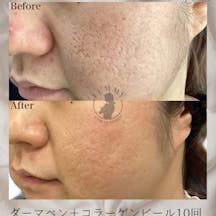 【男性・ニキビ跡】ダーマペンコラーゲンピール・ACRS_before_aftar