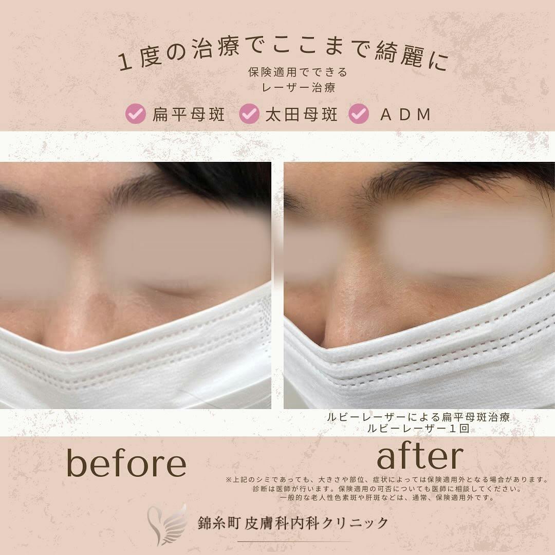 【扁平母斑】ルビーレーザー治療_before_aftar