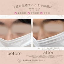 【扁平母斑】ルビーレーザー治療_before_aftar