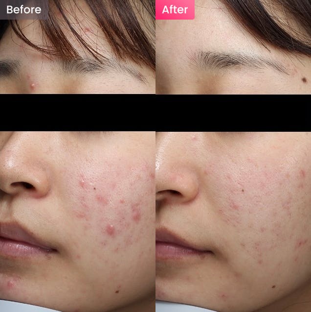 【女性・ニキビ】両頬炎症性ニキビが気になる