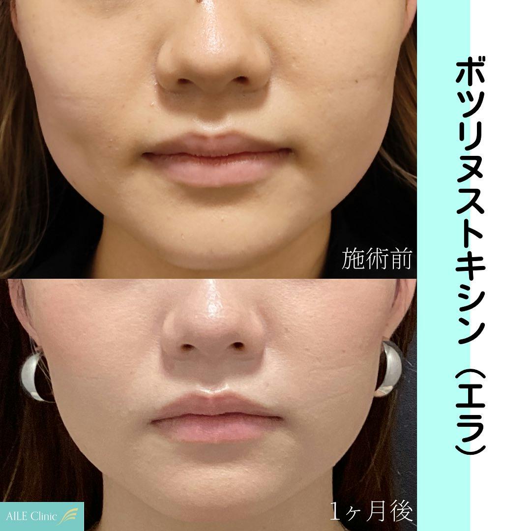 【女性・エラ】ボツリヌストキシン注入_before_aftar