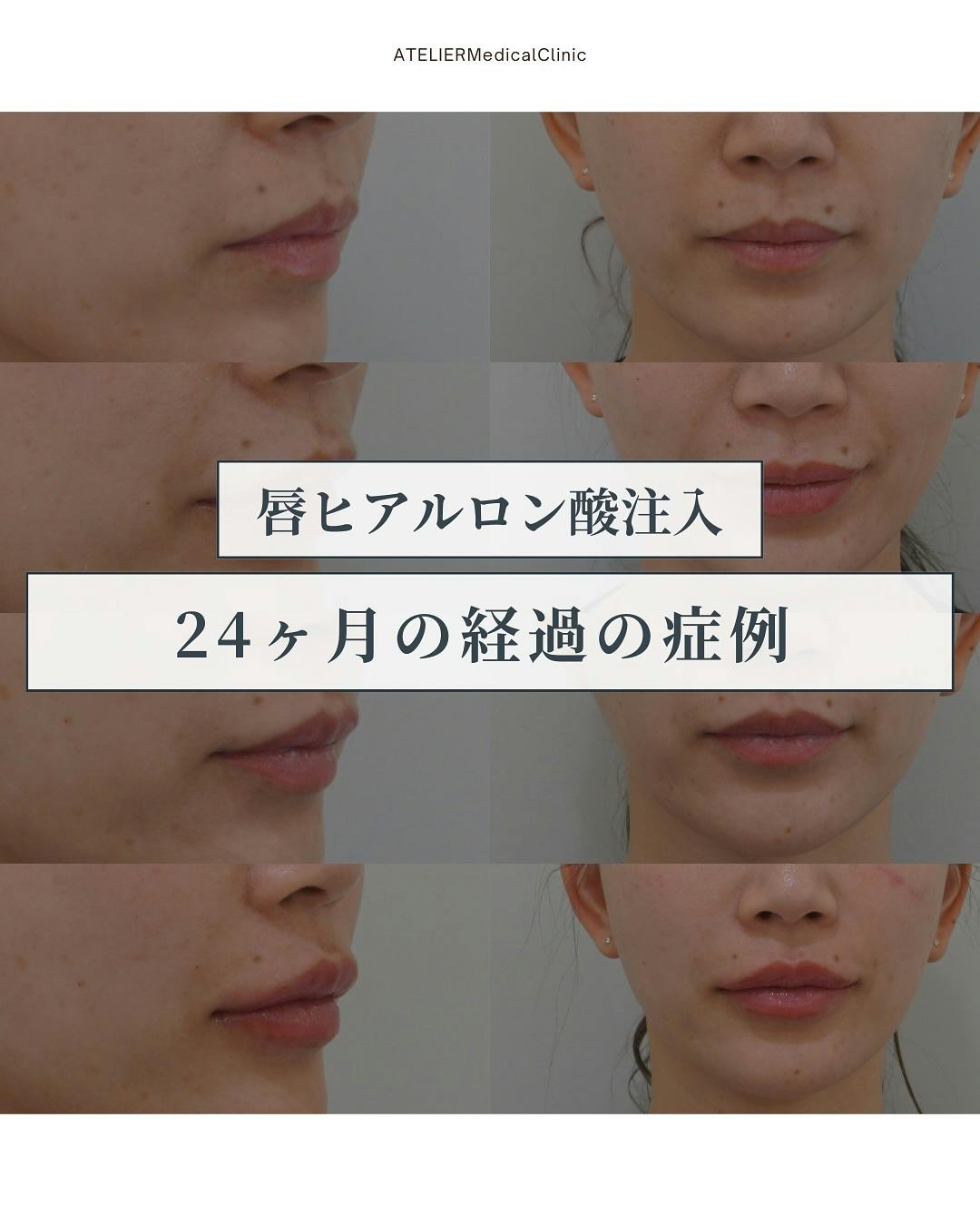 【女性・唇】唇ヒアルロン酸_before_aftar