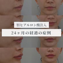 【女性・唇】唇ヒアルロン酸_before_aftar