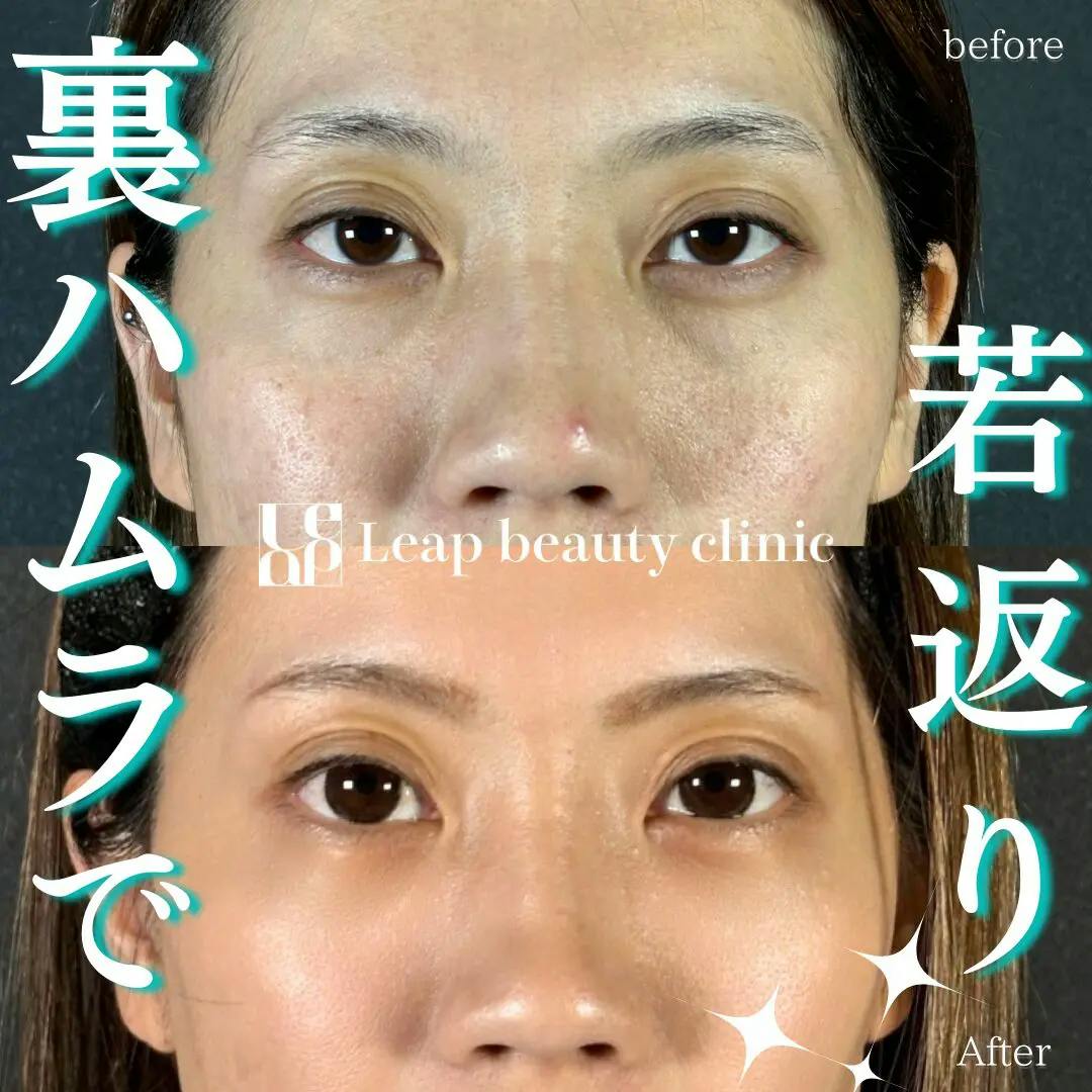 【30代女性・目元】裏ハムラ法_before_aftar