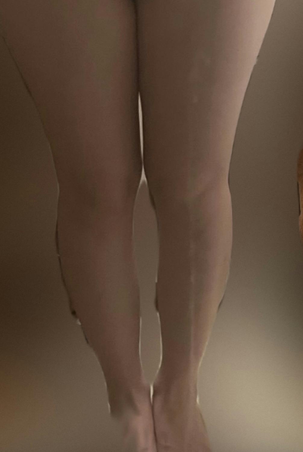 湘南美容クリニック 渋谷院で脹脛太腿脂肪吸引を受けたひのさんの写真