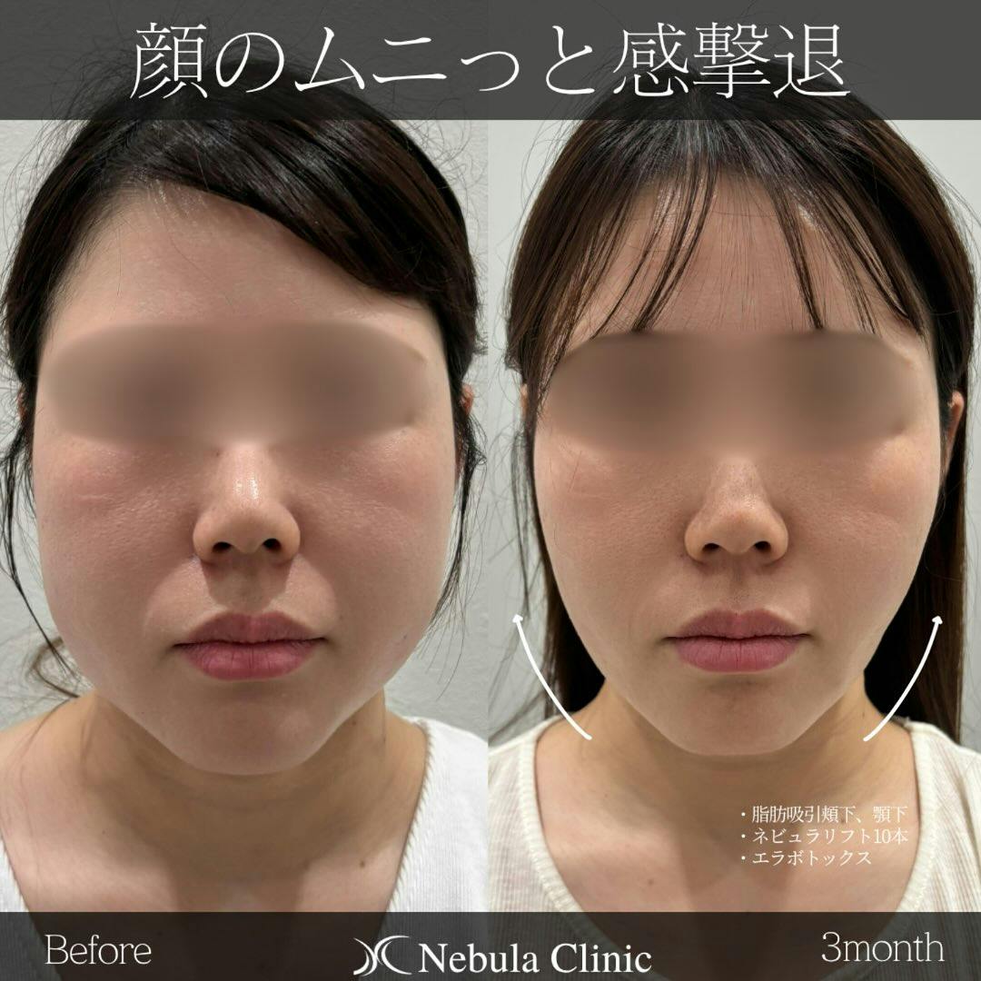 【女性・輪郭】脂肪吸引（頬下・顎下）、ネビュラリフト、エラボトックス_before_aftar