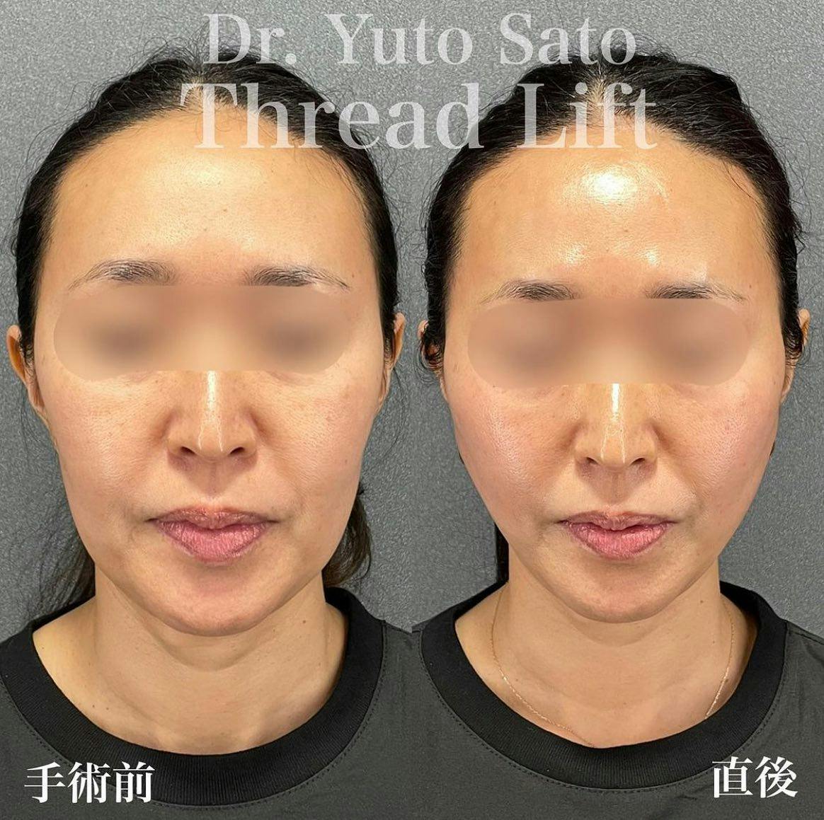 【女性・輪郭】糸リフト ボトックス_before_aftar