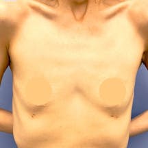 【40代女性・胸】Motivaエルゴノミックス(バッグ豊胸)_before