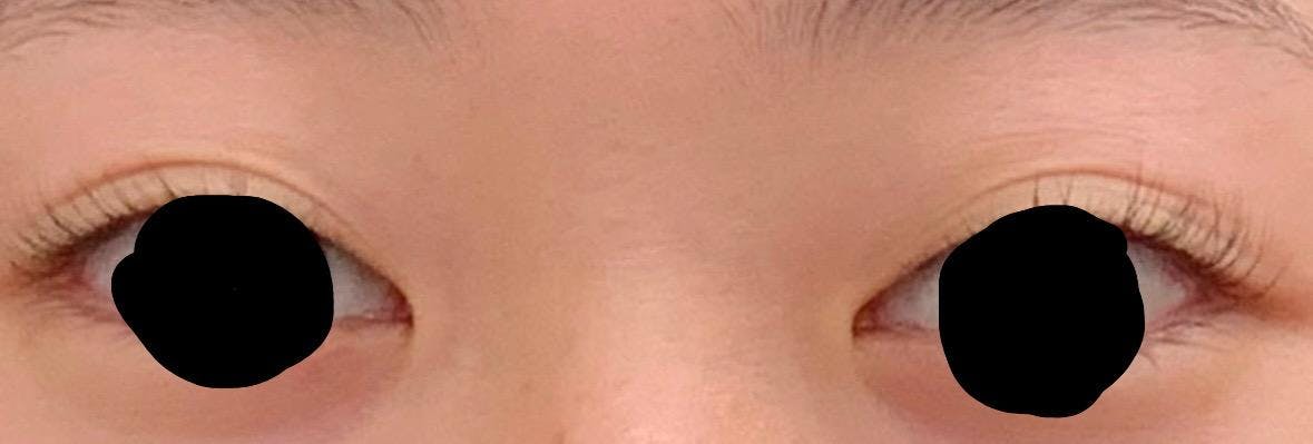 湘南美容クリニック  京都河原町院で二重埋没法：クイックコスメティークダブルを受けたゆぃなさんの写真