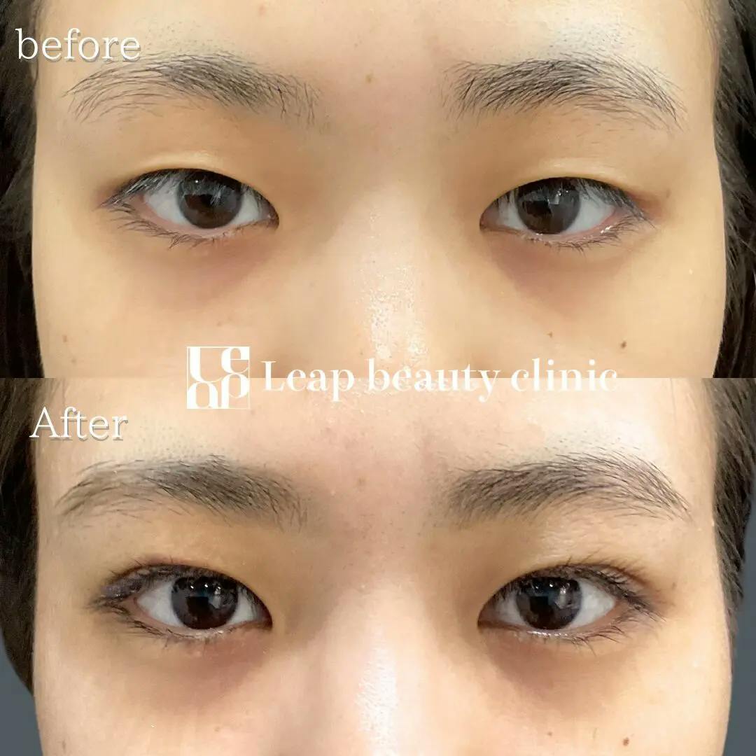 【20代女性・目元】二重埋没法_before_aftar