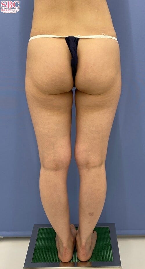 【女性・下半身】Aquicell（アキーセル）脂肪吸引_before