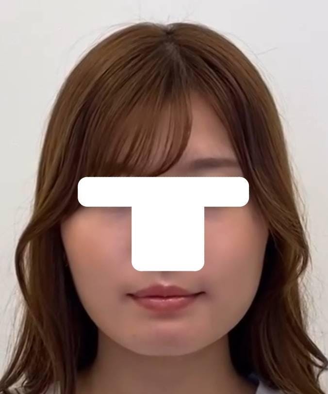 品川美容外科渋谷院（※品川スキンクリニック提携）で糸リフト：美肌アモーレ プレミア（8本）を受けた長友さんの写真
