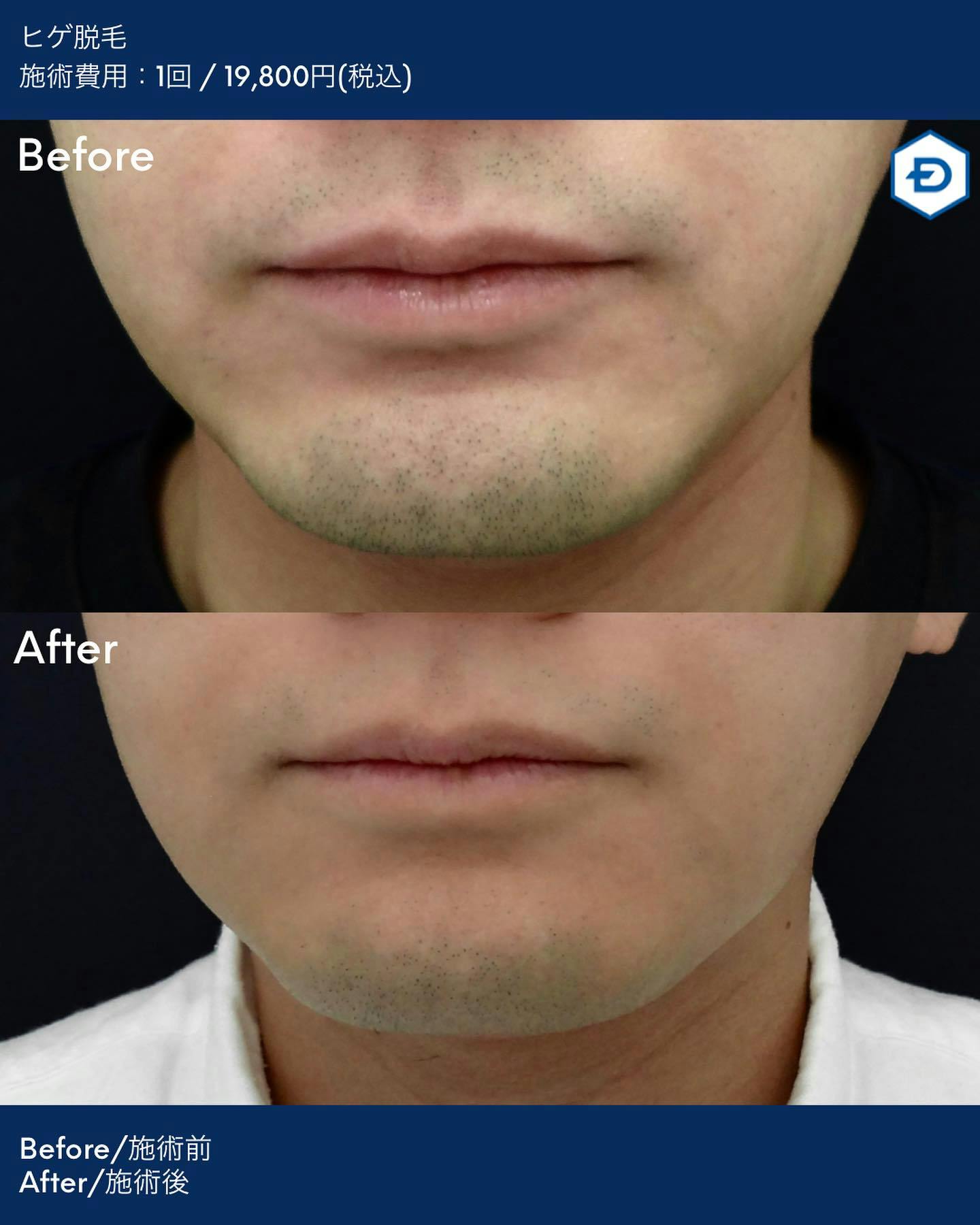 【男性・ヒゲ】ヒゲ脱毛_before_aftar