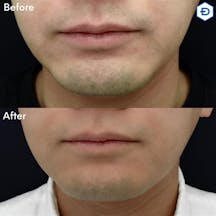 【男性・ヒゲ】ヒゲ脱毛_before_aftar