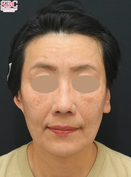 【女性・たるみ】ボトックス（アラガン）_after