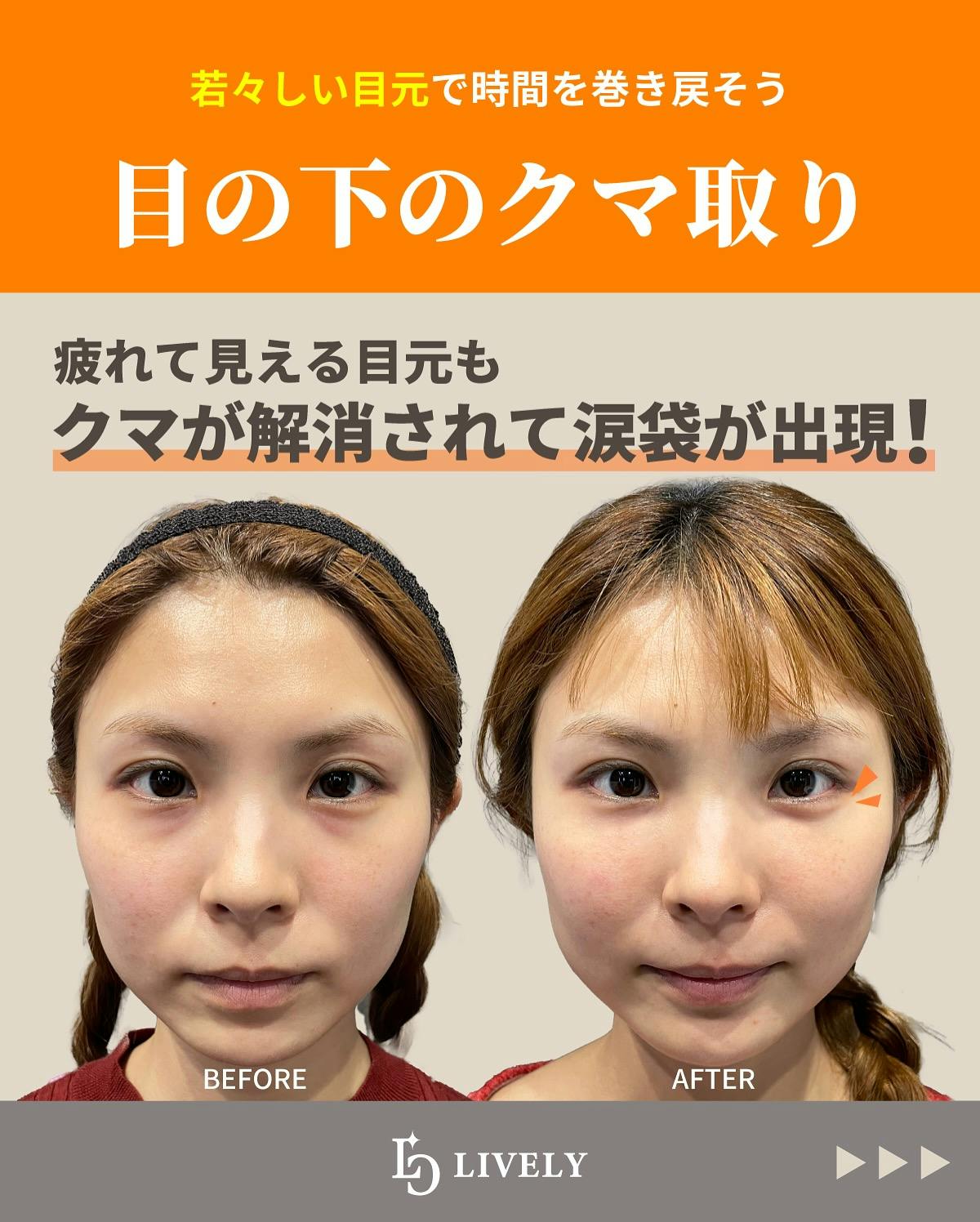 【女性・目】目の下のクマ取り_before_aftar