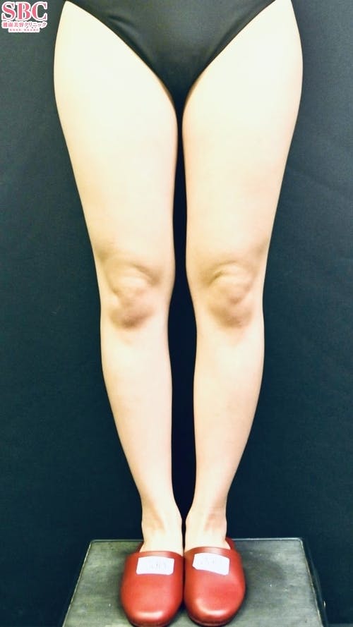 【20代前半女性・脚】Aquicell（アキーセル）脂肪吸引（太もも＋臀部＋膝）_before