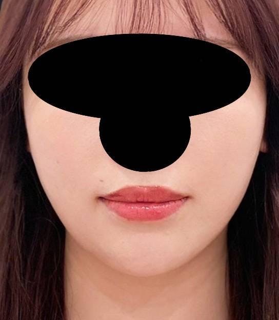 聖心美容クリニック 六本木院で小顔に整形：ボツリヌストキシン注入（注射）を受けたさかもとさんの写真