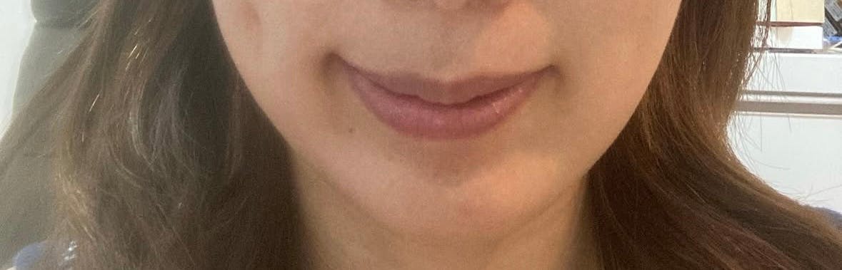 品川スキンクリニック梅田院でボトックス注射・顎のボトックス注射・韓国製ボトックス・ボツリヌストキシン・アラガン製ボトックスを受けたみみこさんの写真