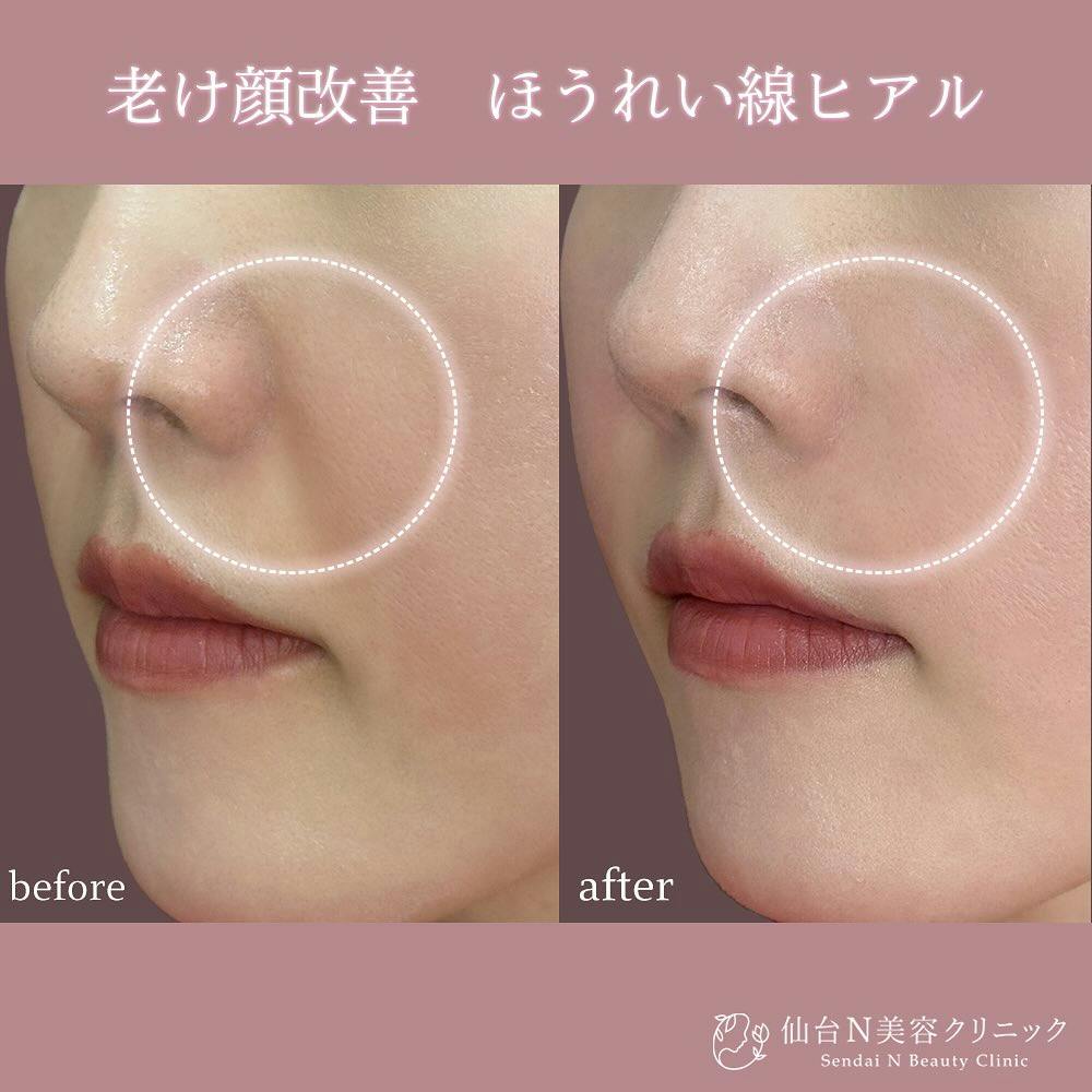 【女性・ほうれい線】ほうれい線ヒアルロン酸_before_aftar