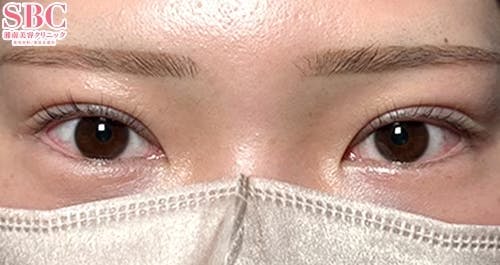 【20代女性・目元】線留めクロス二重術_1week