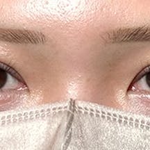 【20代女性・目元】線留めクロス二重術_1week