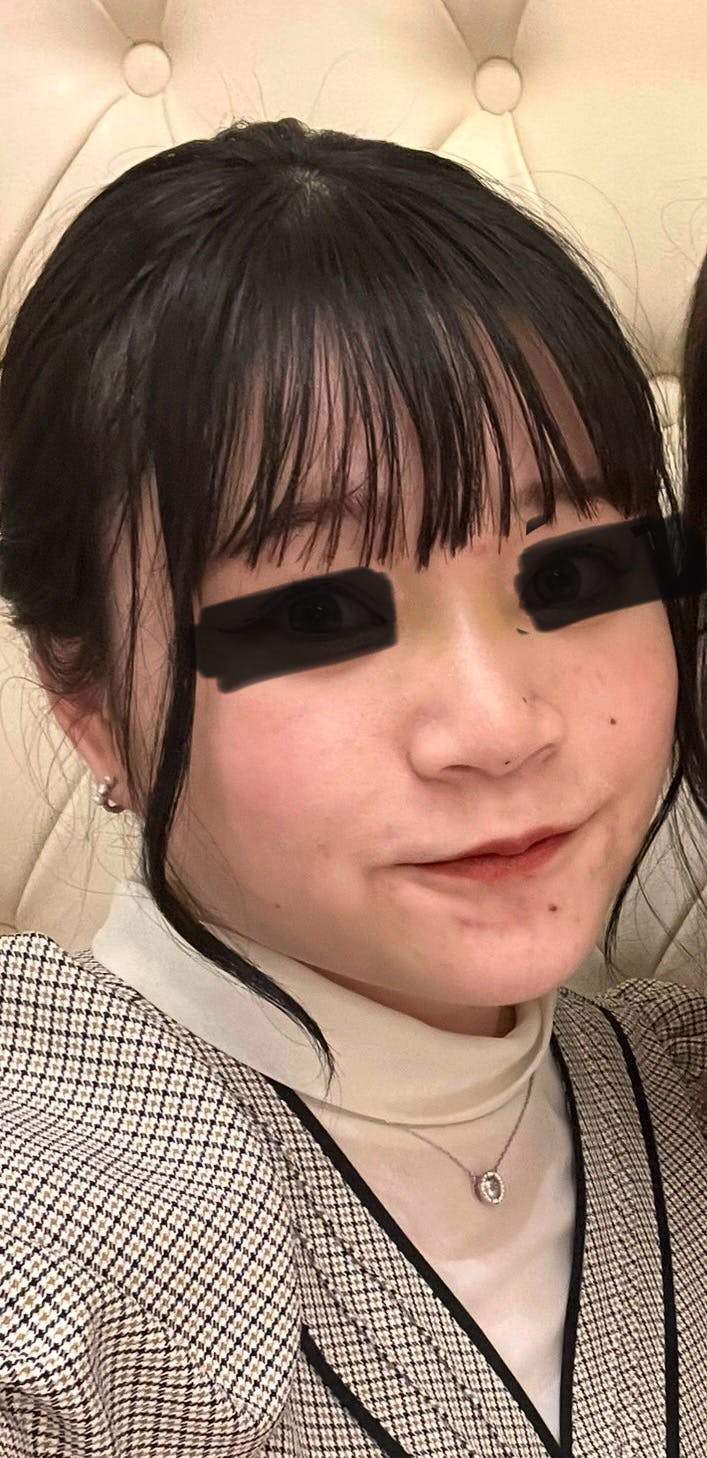 TCB東京中央美容外科 新宿三丁目院でを受けたゆかさんの写真