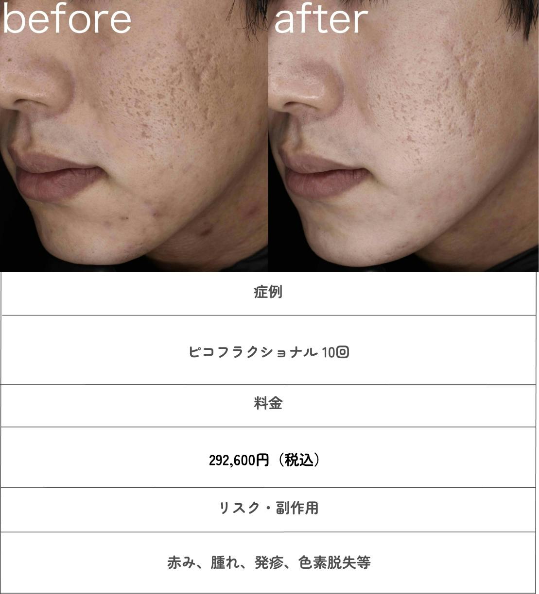 西大寺駅前A皮膚科のニキビ治療のbefore/after