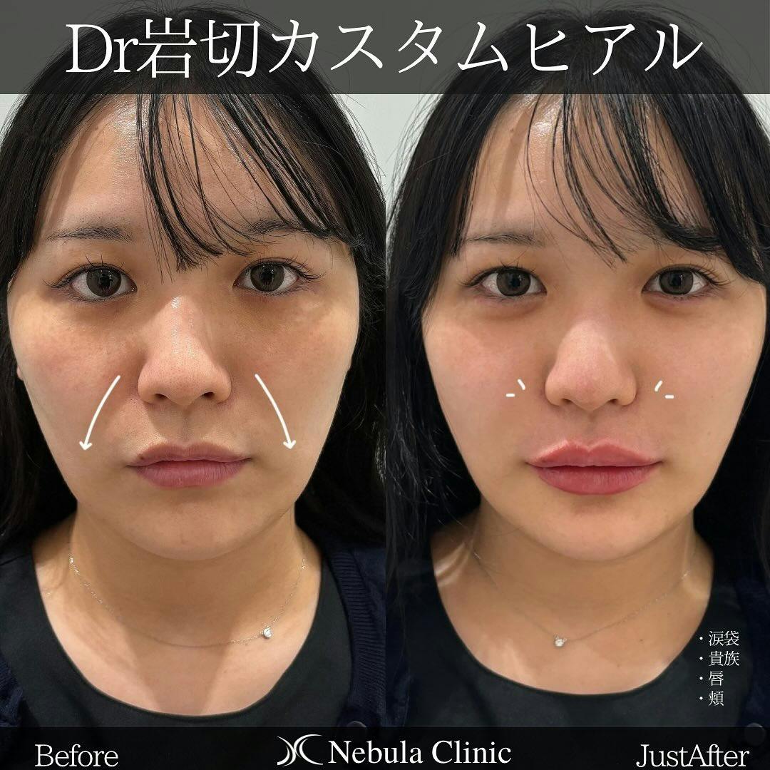 【女性・涙袋・小鼻・唇・頬】ヒアルロン酸注入(涙袋・貴族・唇・頬)_before_aftar