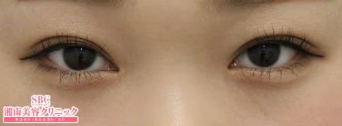 【女性・目元】腫れづらいスクエア二重術_aftar