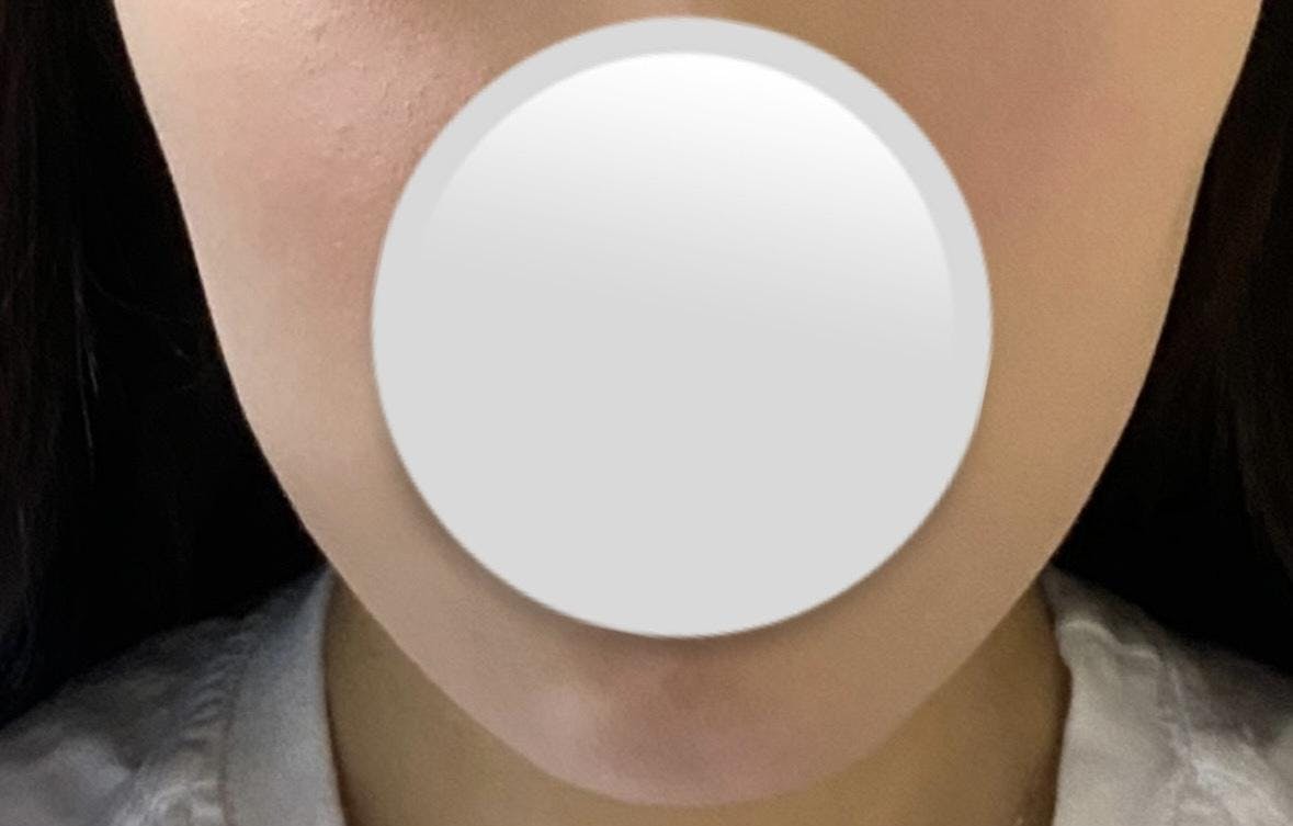 アールビューティークリニック 名古屋院(R Beauty CLINIC)でウルトラセルQハイフを受けたぐーちゃんさんの写真