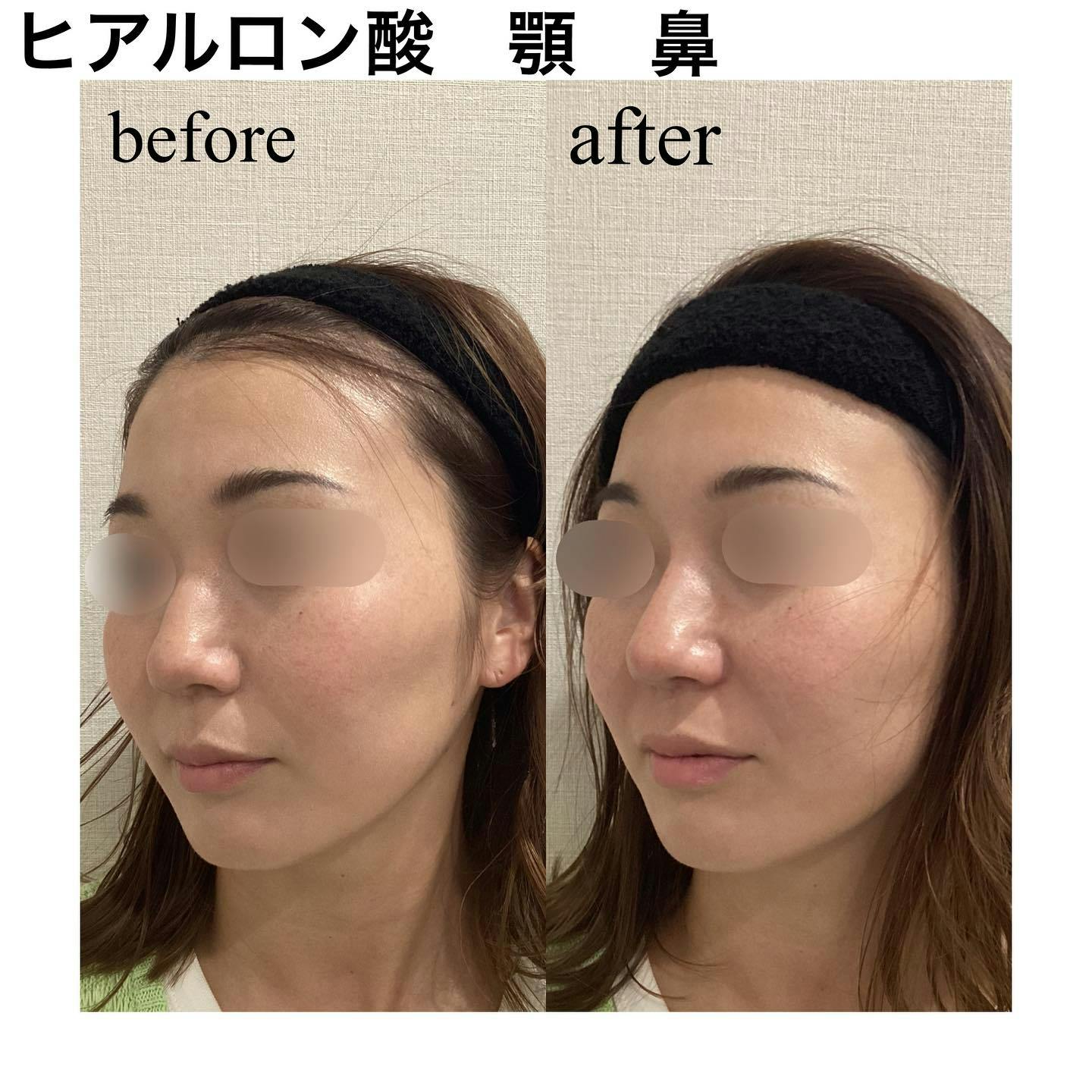 【女性・顔】ヒアルロン酸（鼻根部、鼻先、顎先）_before_aftar