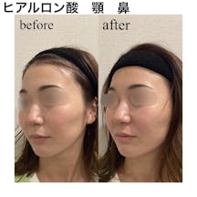 【女性・顔】ヒアルロン酸(鼻根部、鼻先、顎先)_before_aftar