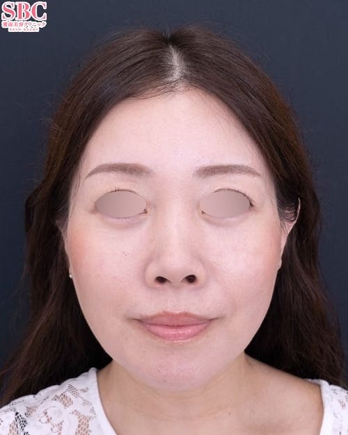 【40代女性・顔】Aquicell（アキーセル）脂肪吸引、ジョールファット除去術、ボトックス、目の下の切らないクマ・たるみ取り 、コンデンスリッチフェイス法 、ナノリッチ、SBCプリマリフト、シークレットリフト_after